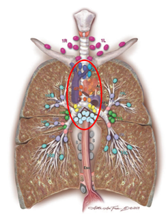 淋巴结转移的局部晚期肺癌（IIIA-N2期），治疗该如何排兵布阵？