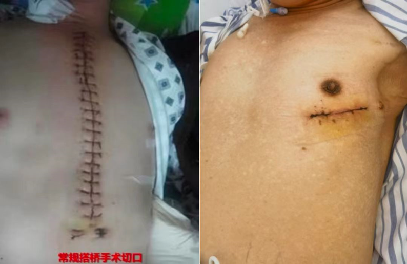 浙江首例！腔镜辅助“全动脉化”心脏搭桥成功实施