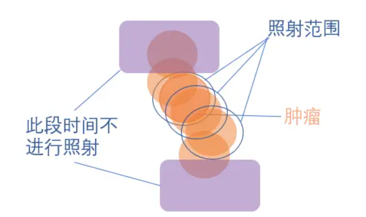 国际肺癌日 | 原来肺癌放疗也可以这么做